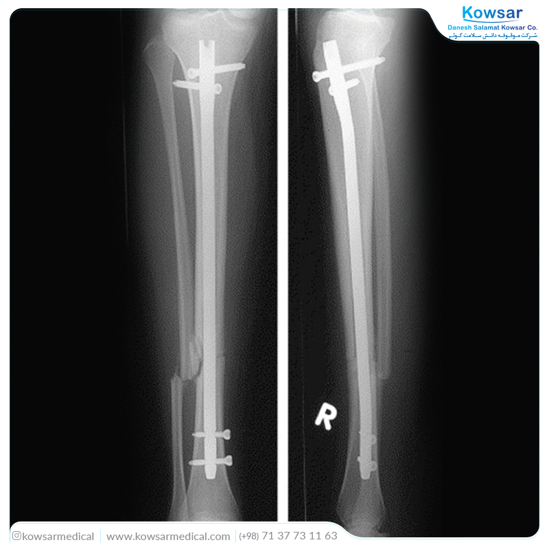 Expert Tibial Nail - تصویر 3
